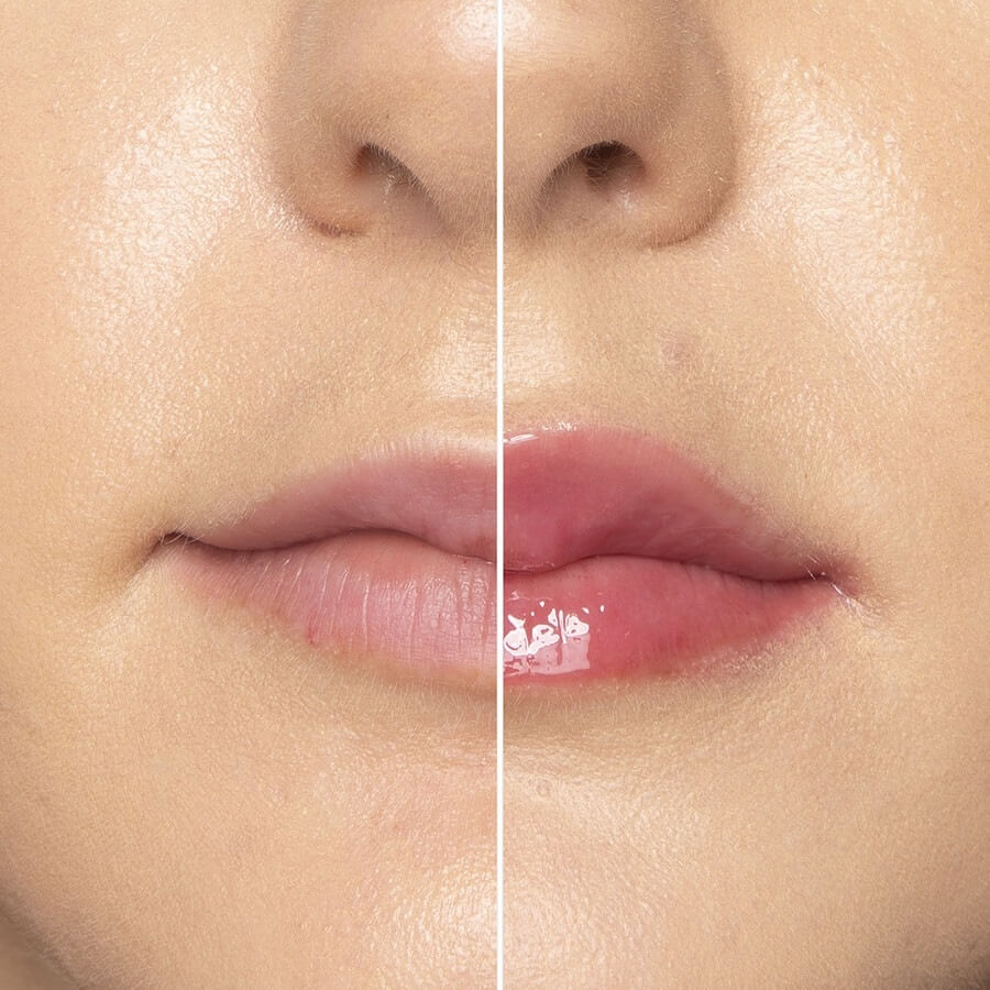Lip Injection  Extreme