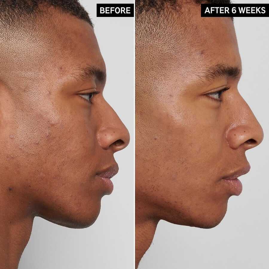 Treatment Mandelic Acid