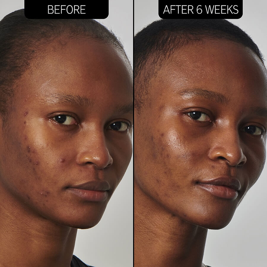 20% Niacinamide Serum