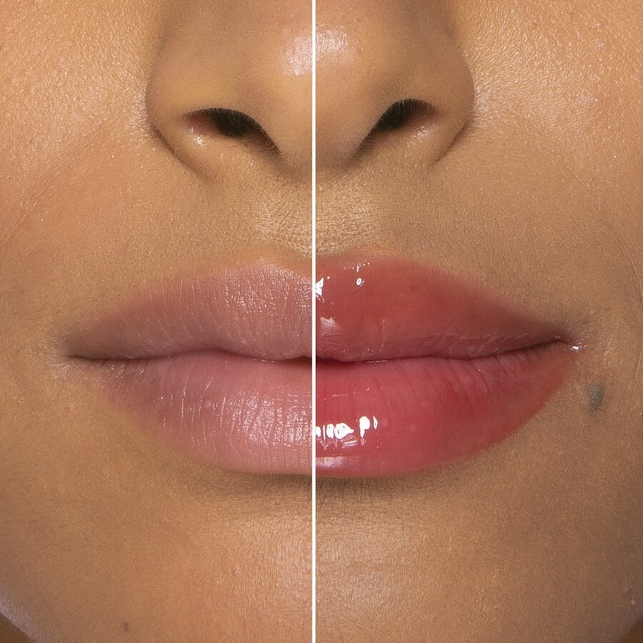 Lip Injection  Extreme