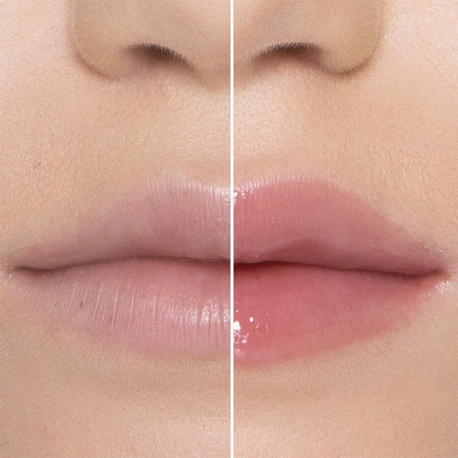 Lip Injection  Extreme