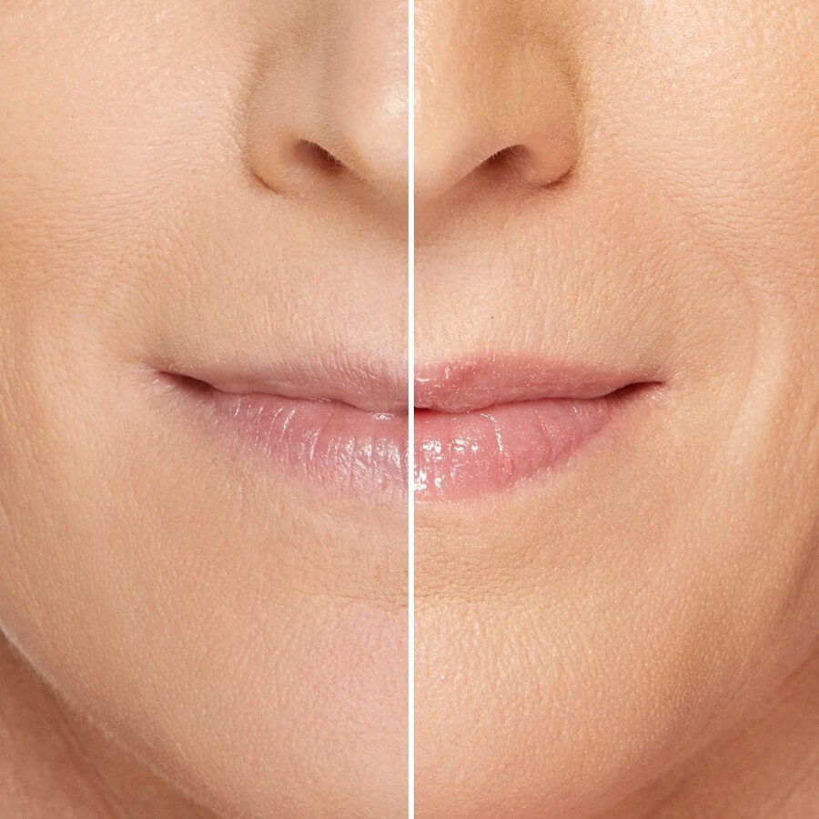 Lip Injection Maximum Plump