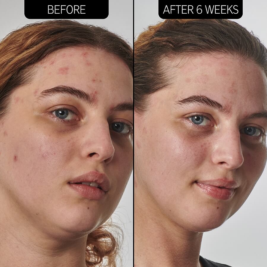 10% Urea Moisturizer