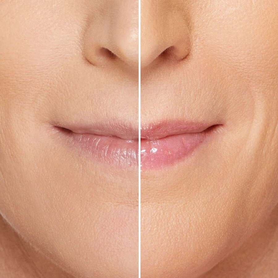 Lip Injection Maximum Plump